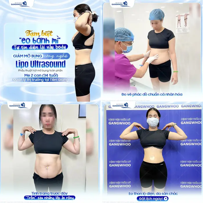 Tạm biệt eo bánh mì tự tin diện đầm dây chỉ sau 1 lần thực hiện giảm mỡ Lipo Ultrasound hiện đại
