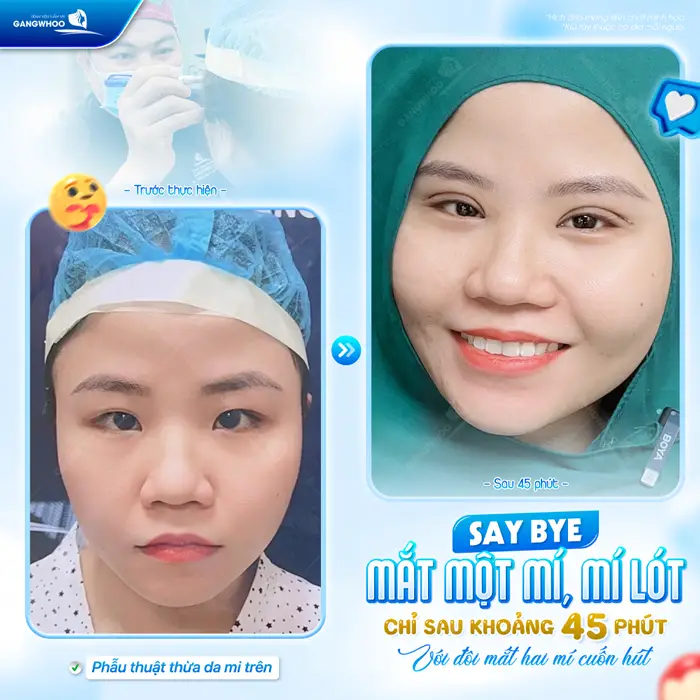 Tạm biệt mắt 1 mí mí lót chỉ sau 45 phút đôi mắt đã đẹp hài hòa và cân đối 