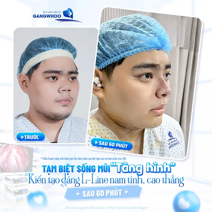 Tạm biệt sống mũi thấp tẹt nâng mũi kiến tạo dáng mũi cao đẹp hoàn hảo, đẹp chuẩn chỉ sau 60 phút thực hiện