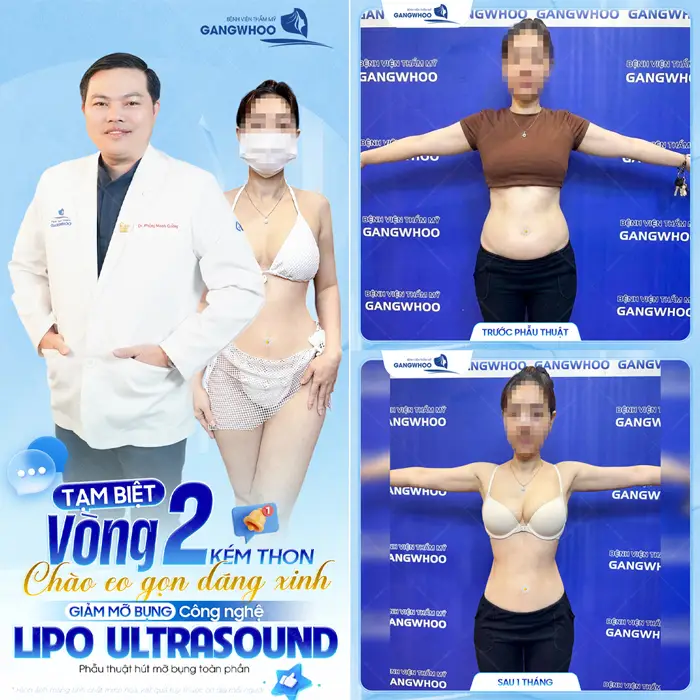 Tạm biệt vòng 2 kém thon gọn chào eo gọn dáng xinh với công nghệ giảm mỡ Lipo Ultrasound hiện đại