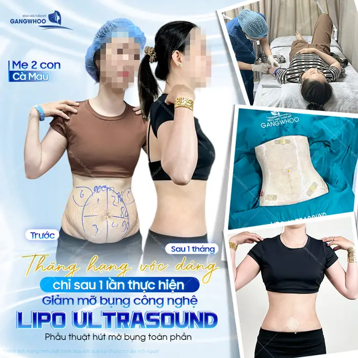 Thăng hạng vóc dáng chỉ sau 1 lần thực giảm mỡ bụng công nghệ Lipo Ultrasound