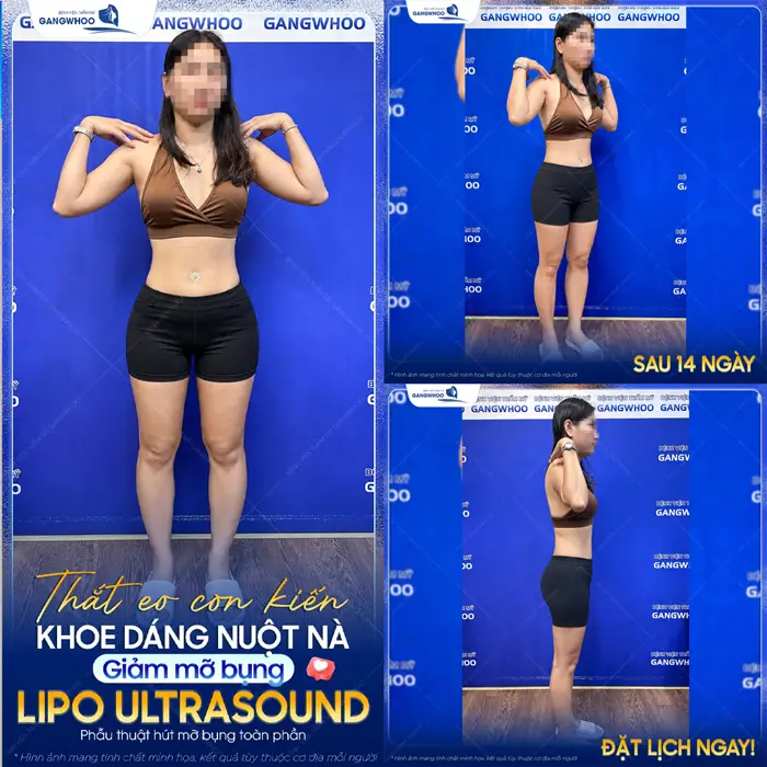 Thắt eo con kiến khoe dáng nuột nà sau giảm mỡ bụng công nghệ Lipo Ultrasound