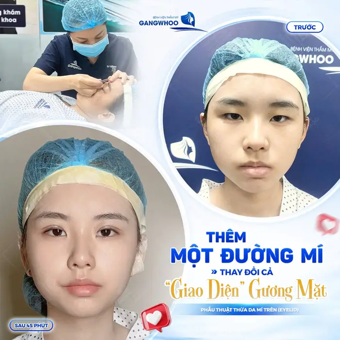 Thêm 1 đường mí thay đổi cả "giao diện" gương mặt bừng nét xinh 