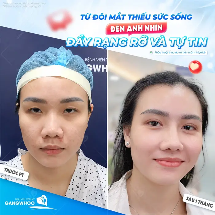 Từ đôi mắt thiếu sức sống đến ánh nhìn đầy rạng rỡ và tràn đầy tự tin 