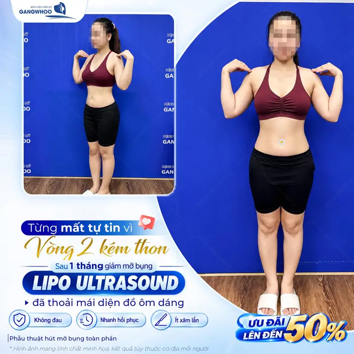 Hút Mỡ Xong Có Béo Lại Không? Chuyên Gia Giải Đáp 1 Từng mất tự ti vì vòng 2 kém thon gọn kết quả sau 1 tháng giảm mỡ bụng công nghệ Lipo Ultrasound hiện đại