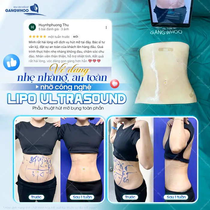 Bụng thon đẹp gọn nhờ phẫu thuật hút mỡ công nghệ Lipo Ultrasound hiện đại 