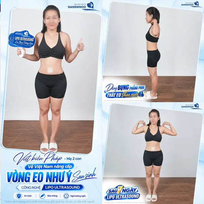 Việt Kiều Pháp về Việt Nam nâng cấp vòng eo đẹp như ý sau 7 ngày đã tự tin khoe dáng xinh đẹp