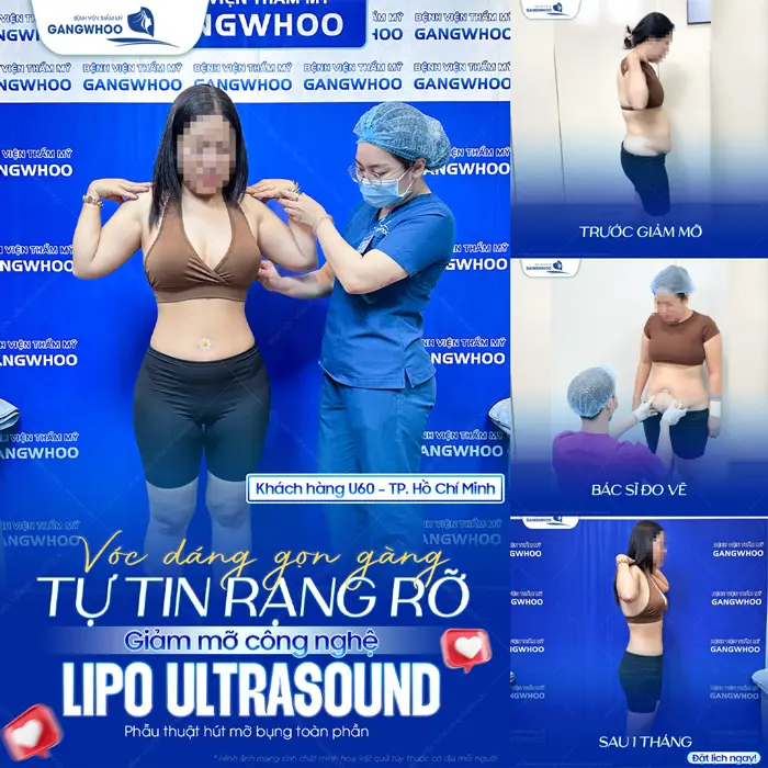 Vóc dáng gọn gàng tự tin rạng rỡ giảm mỡ công nghệ Lipo Ultrasound cho khách hàng U60 eo thon gọn nhẹ 