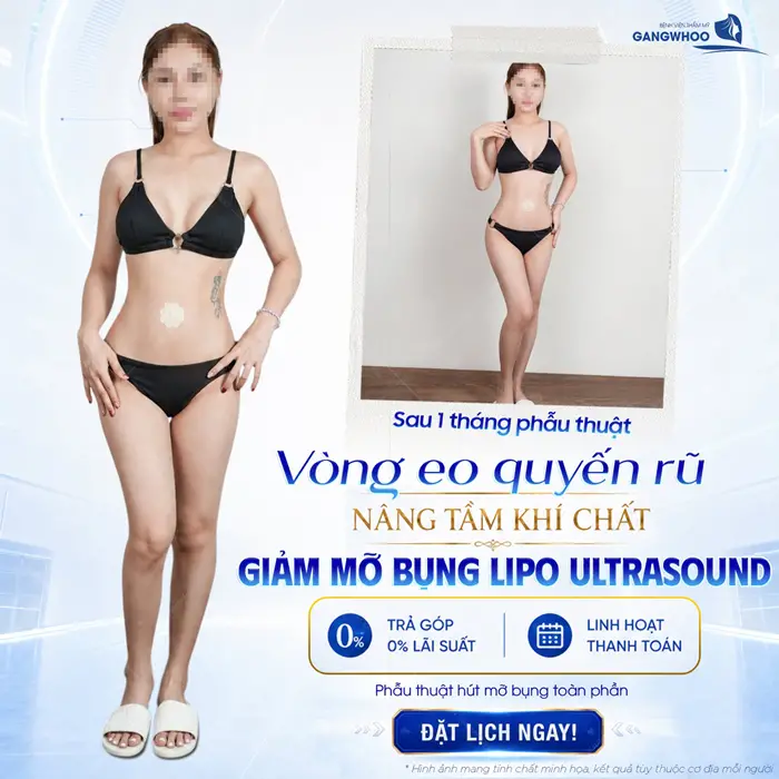 Sau 1 tháng phẫu thuật vòng eo đẹp quyến rũ nâng tầm khí chất sau giảm mỡ bụng công nghệ Lipo Ultrasound