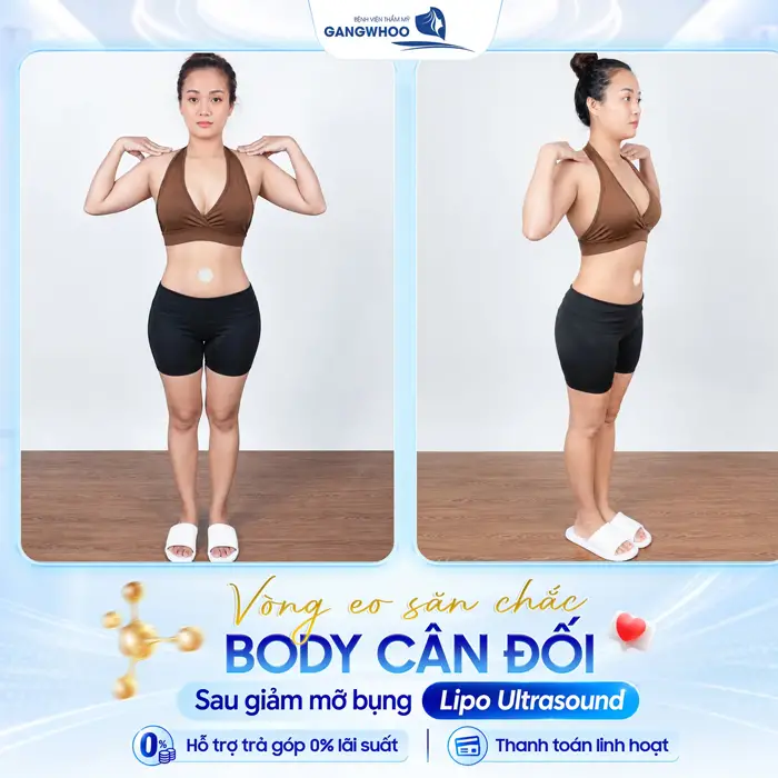 Hút Mỡ Xong Có Béo Lại Không? Chuyên Gia Giải Đáp 4 Vòng eo săn chắc body cân đối sau giảm mỡ bụng công nghệ Lipo Ultrasound hiện đại