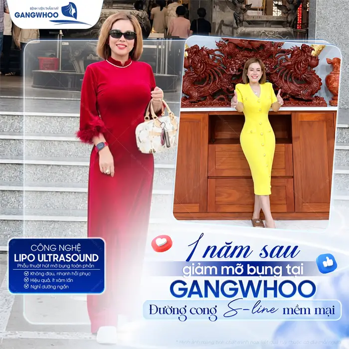 1 năm sau giảm mỡ bụng tại BVTM Gangwhoo đường cong S Line đẹp mềm mại