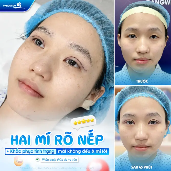 2 mí rõ nếp khắc phục tình trạng mắt không đều và mí lót một cách an toàn và hiệu quả
