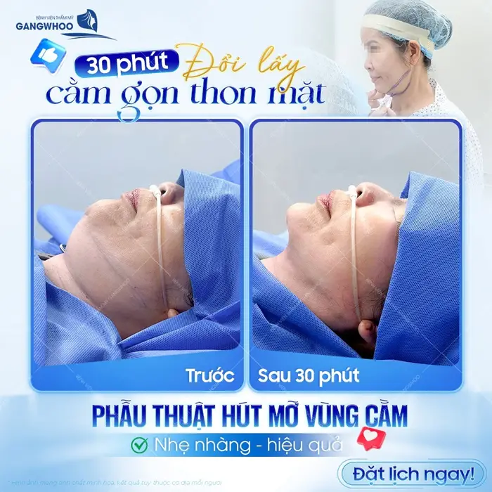 30 phút thay đổi cằm thon gọn sau 30 phút phẫu thuật đã hoàn toàn khác biệt cằm thon gọn đẹp thấy rõ