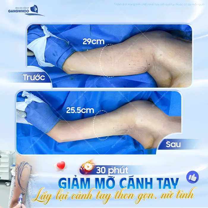 30 phút giảm mỡ cánh tay lấy lại vùng cánh tay thon gọn, nữ tính và nuột nà