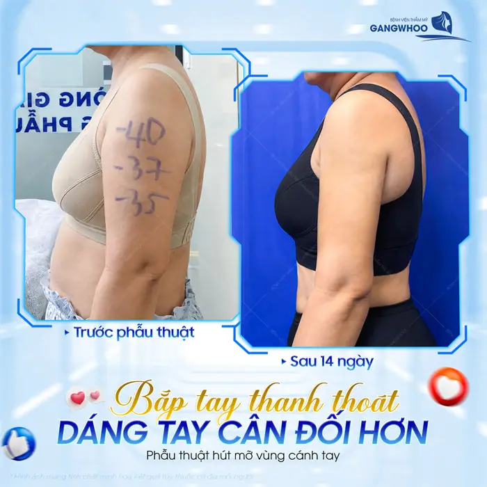 Bắp tay thanh thoát dáng tay đẹp cân đối hơn sự hài hòa với sắc vóc đã cải thiện và thăng hạng hơn thấy rõ