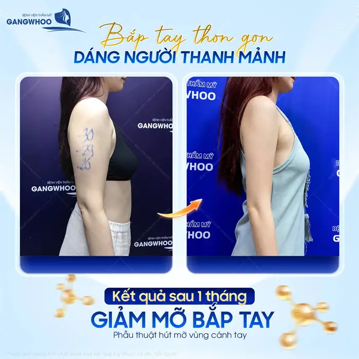 Bắp tay thon gọn dáng người thanh mảnh kết quả sau 1 tháng giảm mỡ bắp tay đã đẹp thon gọn và săn chắc hơn