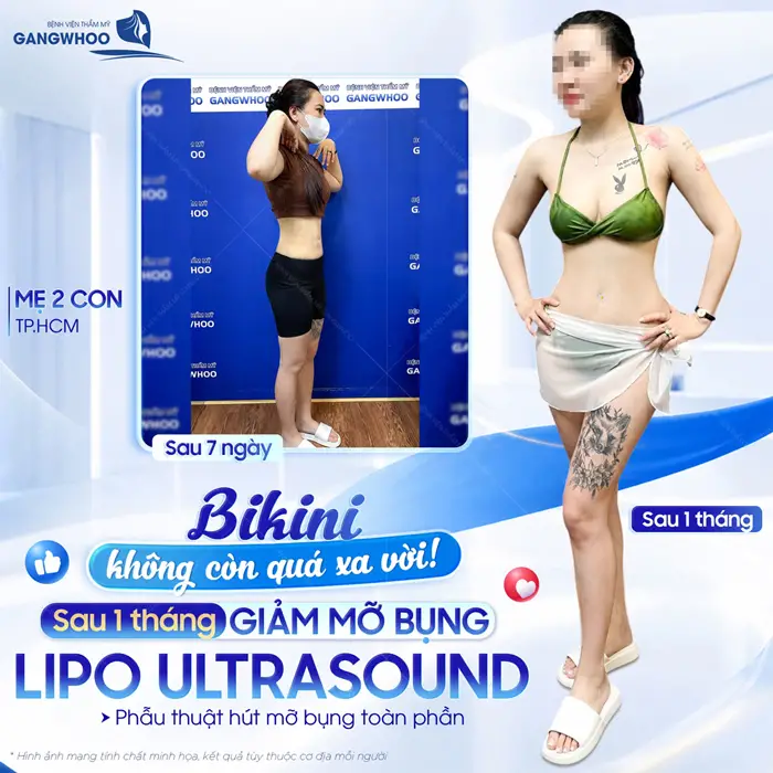Sau 1 tháng giảm mỡ bụng Lipo Ultrasound tự tin khoe dáng đẹp nuột sau giảm mỡ bụng