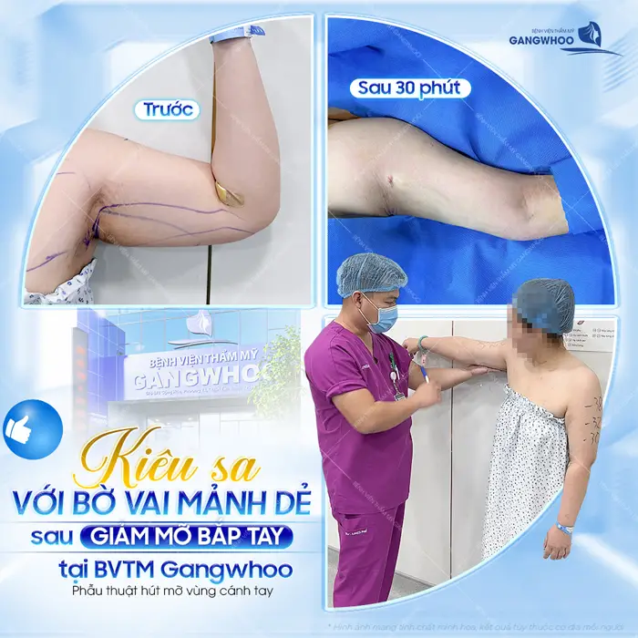 Kiêu sa với bờ vải mảnh dẻ sau giảm mỡ bắp tay tại BVTM Gangwhoo tự tin khoe dáng nuột, eo thon đẹp gọn cuốn hút