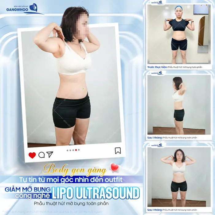 Body đẹp gọn gàng tự tin mọi góc nhìn đến outfit với công nghệ giảm mỡ Lipo Ultrasound hiện đại 