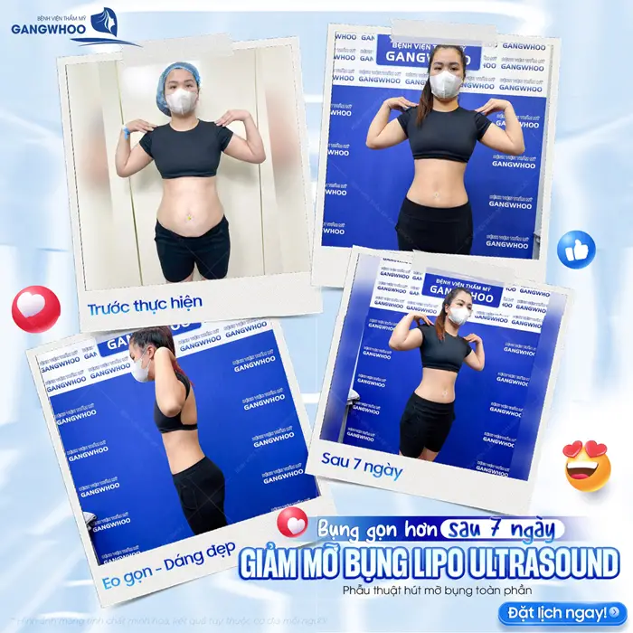 Bụng gọn hơn sau 7 ngày giảm mỡ bụng Lipo Ultrasound eo thon bụng phẳng dáng đẹp xuất sắc