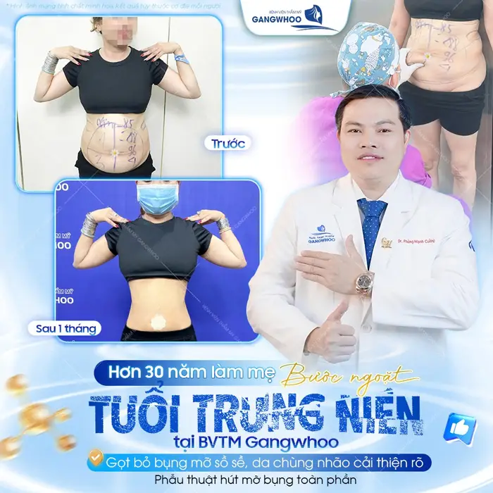 Hơn 30 năm làm mẹ bước ngoặt tuổi trung niên tại BVTM Gangwhoo gạt bỏ bụng mỡ sồ sề, da chùng nhão cải thiện rõ 