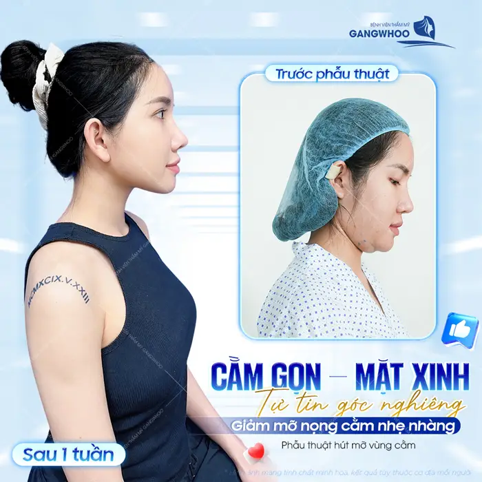 Cằm gọn - Mặt xinh tự tin khoe góc nghiêng với kết quả giảm mỡ nọng cằm nhẹ nhàng và hiệu quả