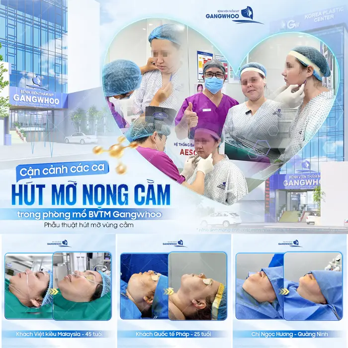 Cận cảnh các ca hút mỡ nọng cằm trong phòng mổ BVTM Gangwhoo an toàn và hiệu quả ngay tức khắc