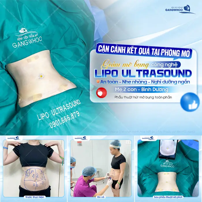 Cận cảnh kết quả tại phòng mổ giảm mỡ bụng công nghệ Lipo Ultrasound an toàn, nhẹ nhàng và nghỉ dưỡng ngắn