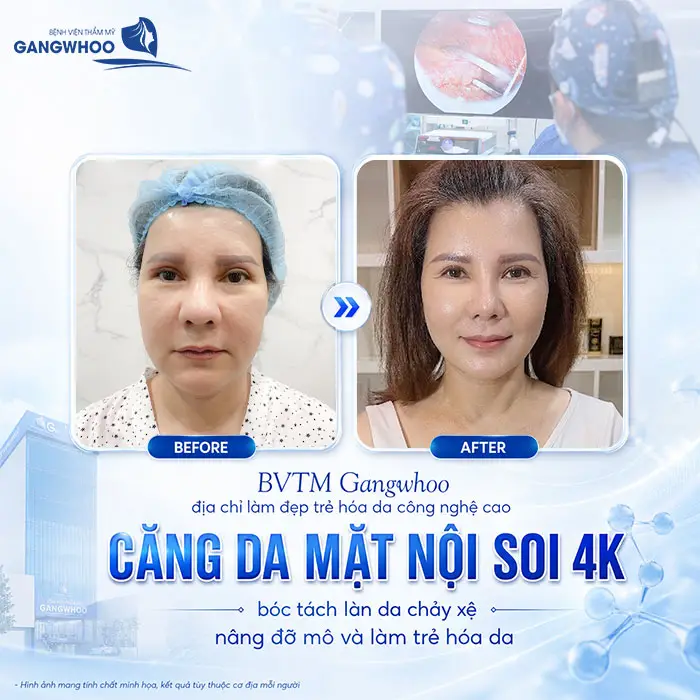 Căng Da Mặt Bằng Chỉ Diamond - Trẻ Hóa Làn Da Chảy Xệ