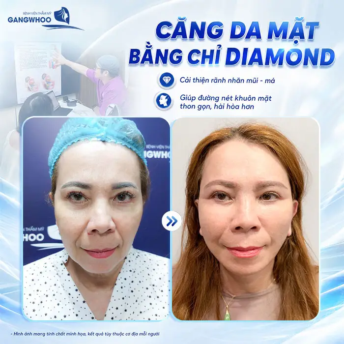 Căng Da Mặt Bằng Chỉ Diamond - Trẻ Hóa Làn Da Chảy Xệ