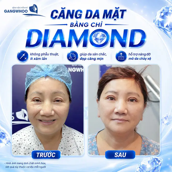 Căng Da Mặt Bằng Chỉ Diamond - Trẻ Hóa Làn Da Chảy Xệ