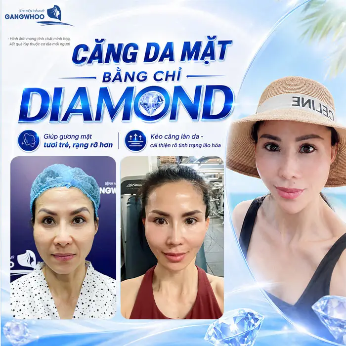 Căng Da Mặt Bằng Chỉ Diamond - Trẻ Hóa Làn Da Chảy Xệ