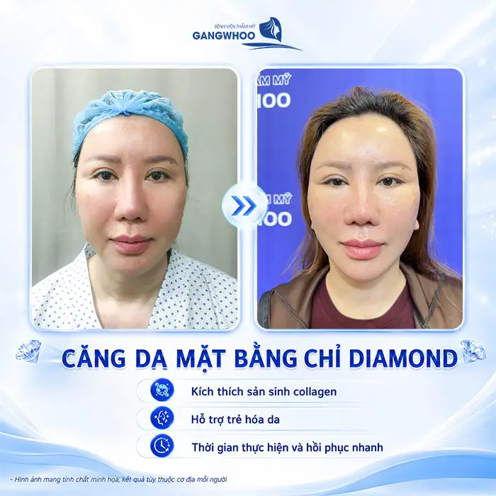 Căng Da Mặt Bằng Chỉ Diamond - Trẻ Hóa Làn Da Chảy Xệ