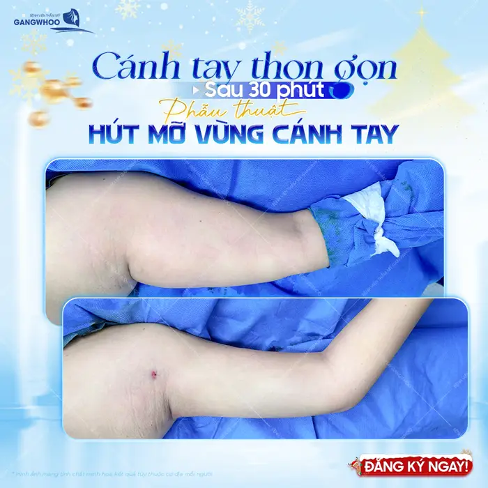 Cánh tay thon gọn chỉ sau 30 phút phẫu thuật hút mỡ vùng cánh tay đã hoàn toàn thay đổi 