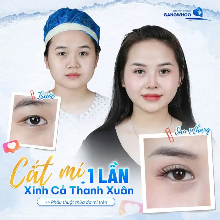 Cắt mí 1 lần xinh cả thanh xuân sau phẫu thuật thừa da mí trên nếp mí đẹp to tròn và rạng rỡ