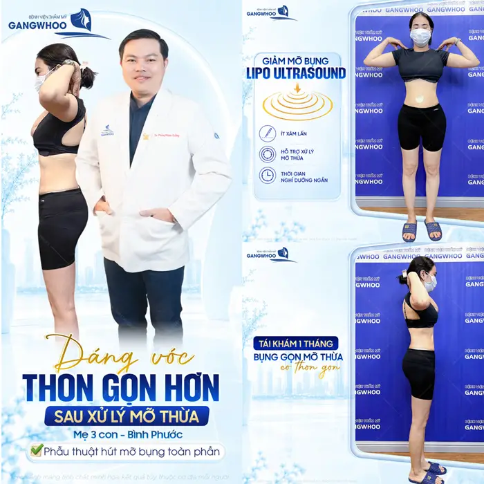 Dáng vóc thon gọn hơn sau xử lý mỡ thừa của mẹ 3 con đến từ Bình Phước