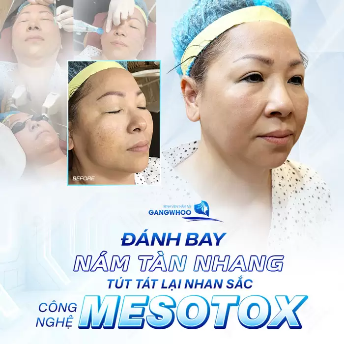 Điều Trị Nám Mesotox - Công Nghệ Đánh Bay Nám Hàn Quốc 5 Không còn làn da nhiều nám, tàn nhang chỉ sau 1 liều trình Mesotox