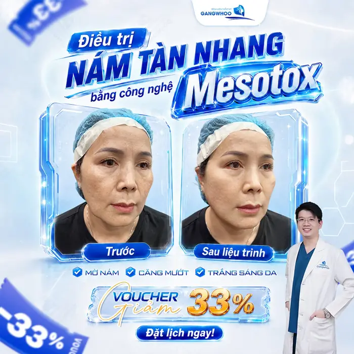 Điều Trị Nám Mesotox - Công Nghệ Đánh Bay Nám Hàn Quốc 6 Điều trị nám tàn nhang bằng công nghệ Mesotox với voucher ưu đãi cực sốc