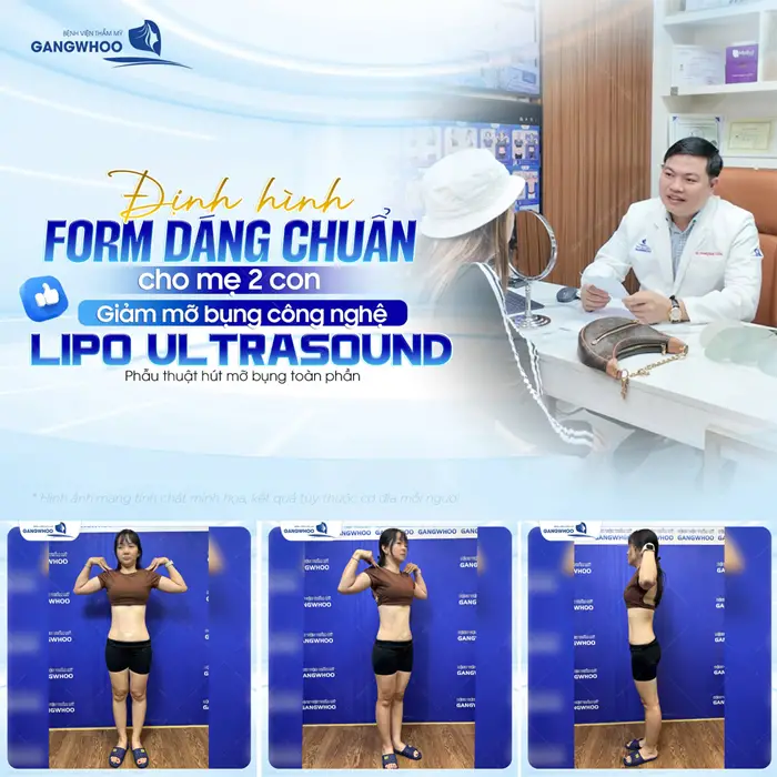 Định hình form dáng chuẩn của mẹ 2 con sau giảm mỡ bụng công nghệ Lipo Ultrasound hiện đại