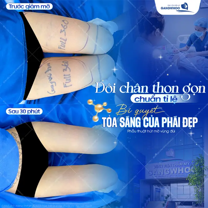 Đôi chân thon gọn chuẩn tỷ lệ bí quyết tỏa sáng của phái đẹp sau phẫu thuật đôi chân thon gọn hài hòa hơn đáng kể