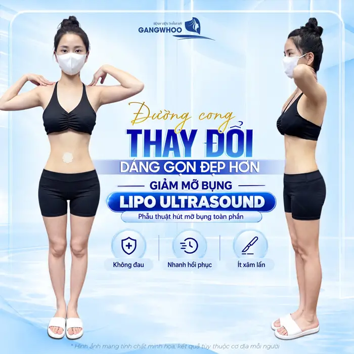 Hút Mỡ Có Giảm Cân Không? Sự Thật Về Hút Mỡ Bụng 6 Đường cong thay đổi dáng gọn đẹp hơn sau giảm mỡ bụng ứng dụng công nghệ Lipo Ultrasound
