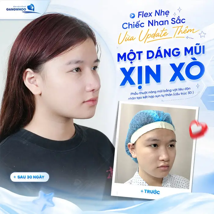 Nâng Mũi Có Thay Đổi Khuôn Mặt Không? 6 Khách Review 1 Flex nhẹ chiếc nhan sắc đẹp chuẩn diện mạo tôn lên đường nét cuốn hút cho khuôn mặt