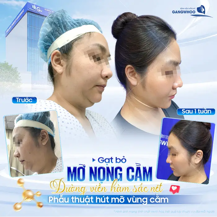 Gạt bỏ mỡ nọng cằm đường viền hàm đẹp sắc nết chỉ sau 1 lần can thiệp phẫu thuật hút mỡ nọng cằm