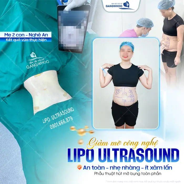 Giảm mỡ công nghệ Lipo Ultrasound an toàn, nhẹ nhàng và ít xâm lấn 