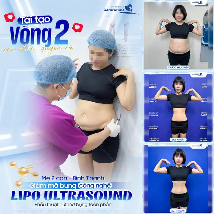 Tái tạo vòng 2 săn chắc và quyến rũ cho mẹ 2 con đén từ Bình Thạnh sau giả mỡ công nghệ Lipo Ultrasound