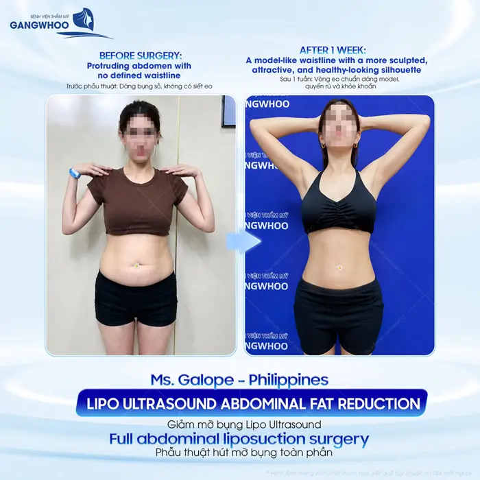 Giảm mỡ bụng Lipo Ultrasound phẫu thuật hút mỡ toàn thân tự tin khoe eo thon đẹp gọn hiệu quả