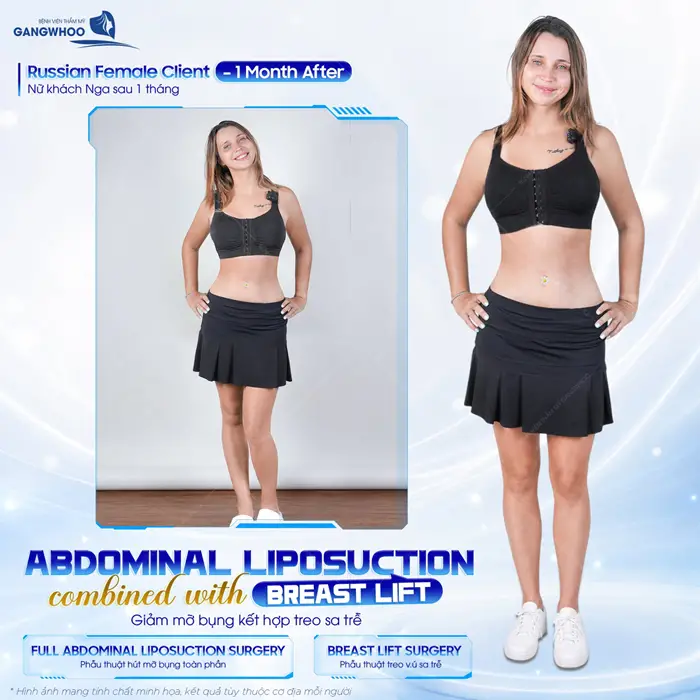 Giảm mỡ bụng kết hợp treo sa trễ body đẹp xuất sắc ngày càng tôn lên đường nét hài hòa và chuẩn tỷ lệ