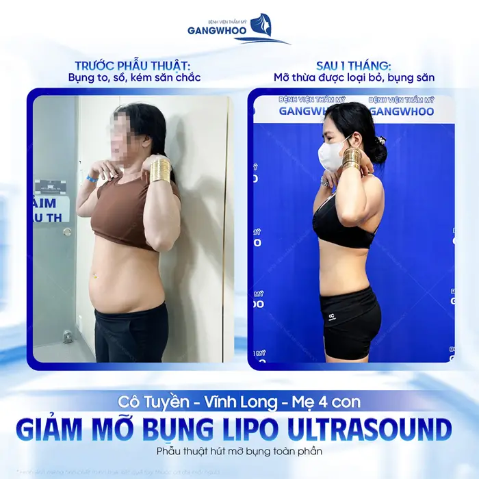 Giảm mỡ bụng Lipo Ultrasound sau 1 tháng mỡ thừa được loại bỏ, bụng gọn eo thêm săn chắc