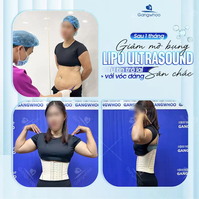 9 Lưu Ý Sau Khi Hút Mỡ Bụng Để Nhanh Chóng Hồi Phục 26 Sau 1 tháng giảm mỡ bụng Lipo Ultrasound tự tin trở lại với vóc dáng săn chắc nhanh hồi phục
