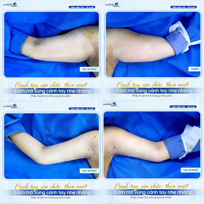 Cách Chăm Sóc Sau Hút Mỡ Bắp Tay Chuẩn 6 Điều Bắt Buộc 5 Cánh tay thon gọn, săn chắc sau 30 phút giảm mỡ kết quả đã hoàn toàn thay đổi rõ rệt